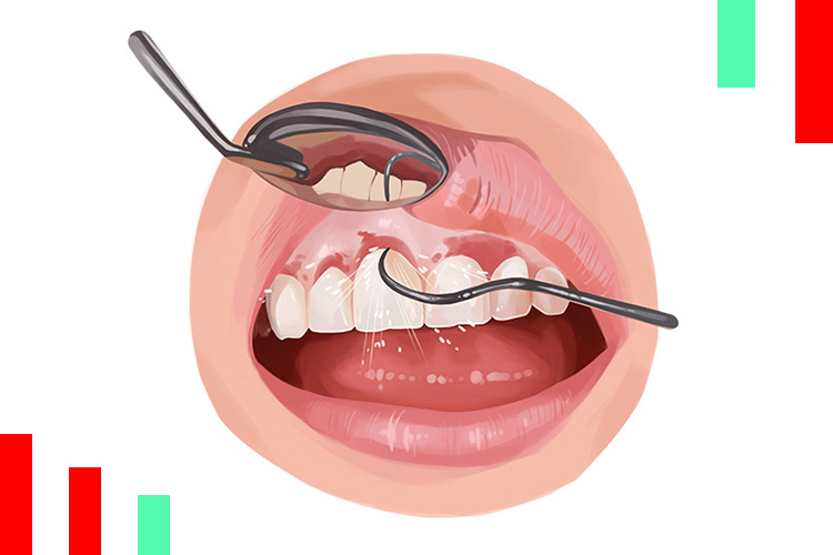 عفونت در ایمپلنت دندان
