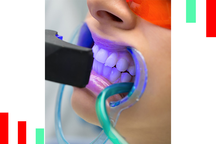 مراحل-بلیچینگ-دندان