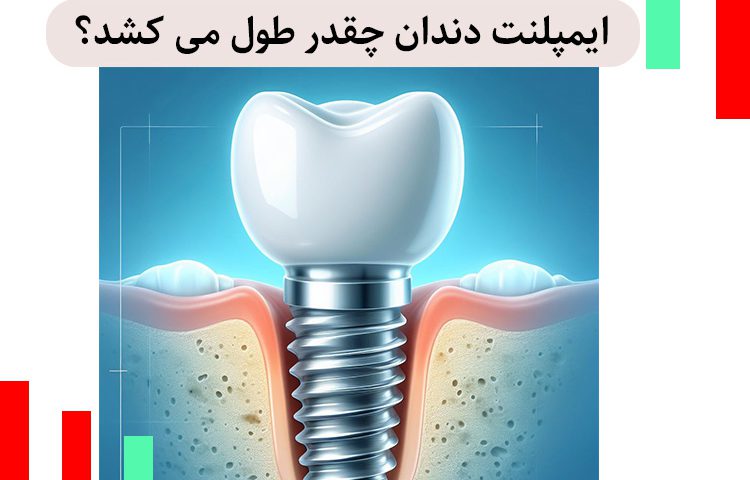 ایمپلنت دندان چقدر طول می‌کشد