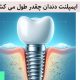 ایمپلنت دندان چقدر طول می‌کشد