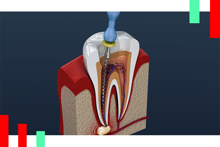 عصب-کشی-دندان