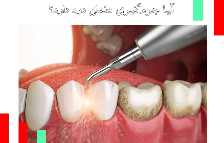 آیا جرم‌گیری دندان درد دارد؟