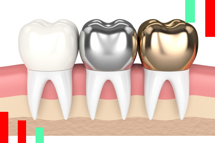 انواع روکش دندان