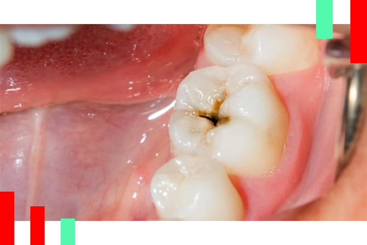 عوارض-ترمیم-دندان
