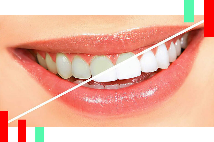 سفید-کردن-دندان
