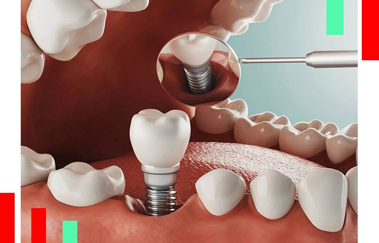 انواع-ایمپلنت-دندان