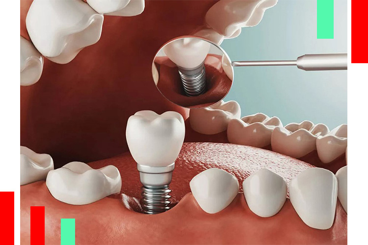 انواع-ایمپلنت-دندان
