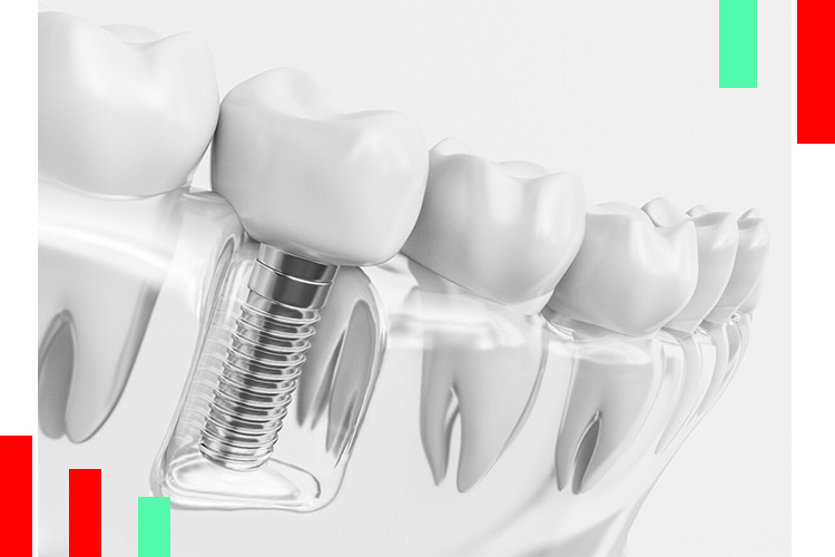 انواع ایمپلنت دندان از نظر مواد سازنده