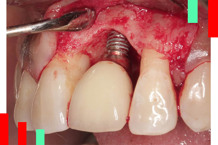 انواع ایمپلنت دندان از نظر کارایی