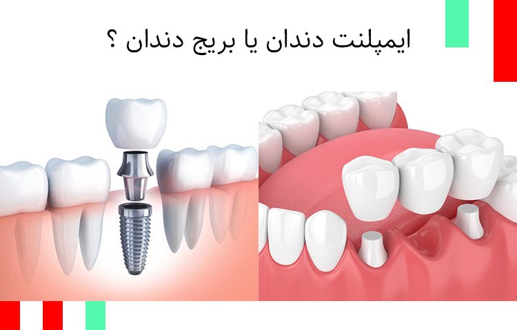 ایمپلنت یا بریج دندان ؟
