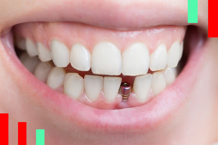 طول عمر ایمپلنت های دندان